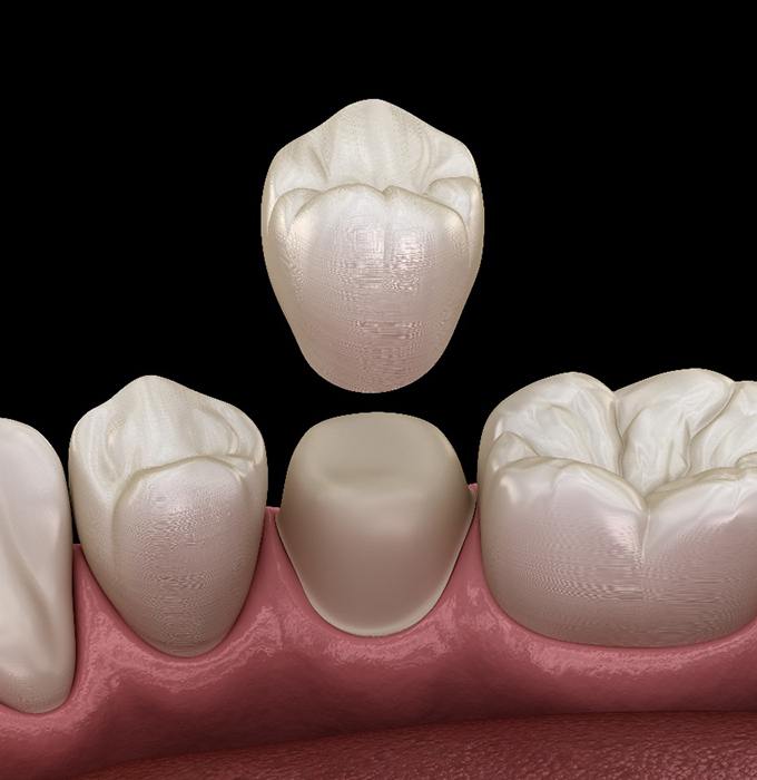 A 3D illustration of a dental crown being placed