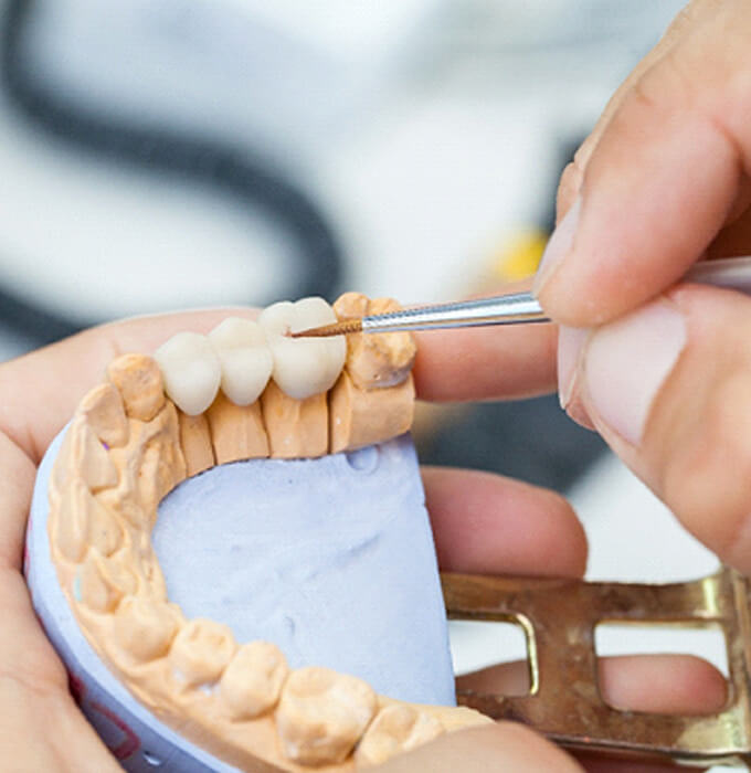 Dental bridge on a model