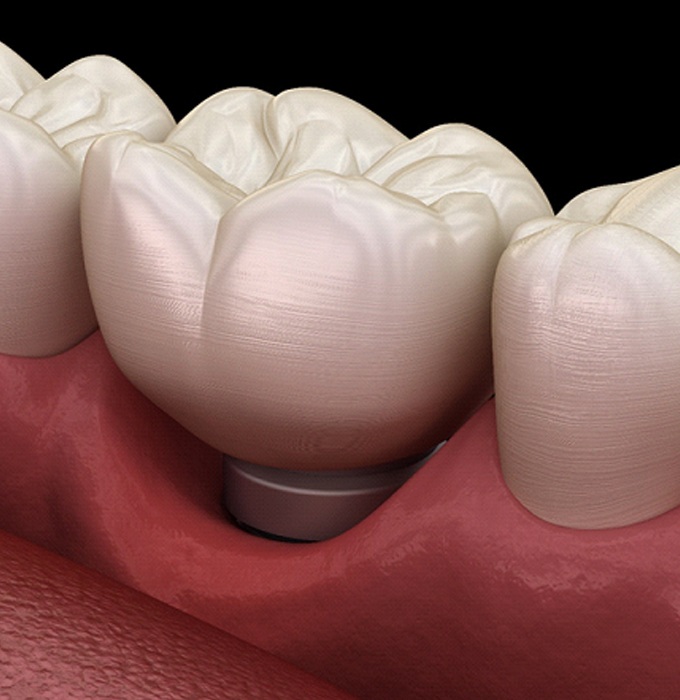 Gum recession, a sign of dental implant failure