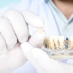 Dentist holding dental implant restoration in Chelsea and model jaw
