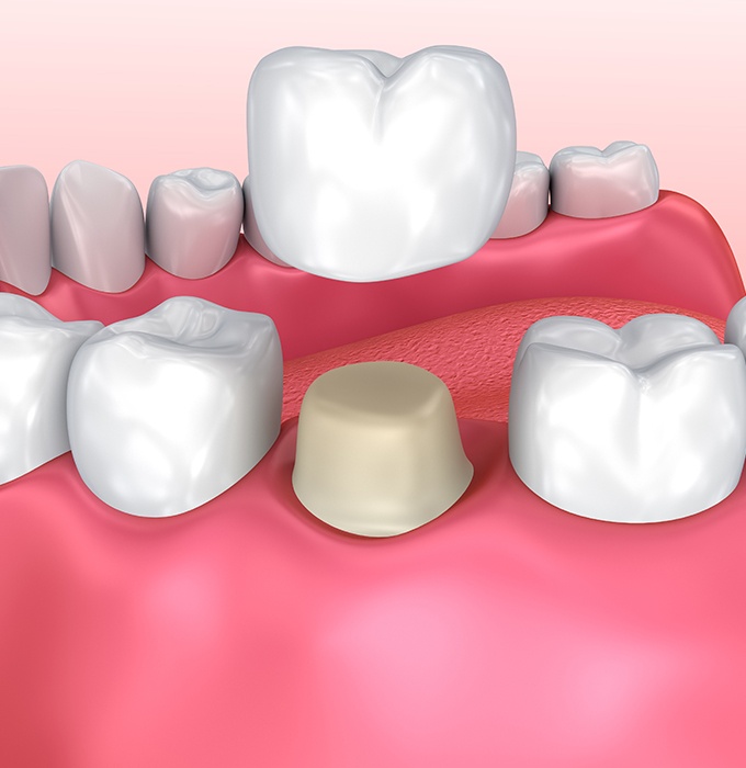 Animated dental crown placement