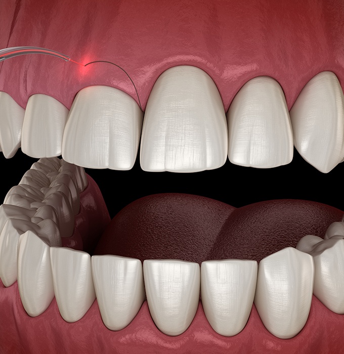 Closeup of smile during laser gum recontouring treatment