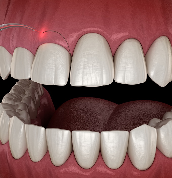 Closeup of smile during laser gum recontouring treatment