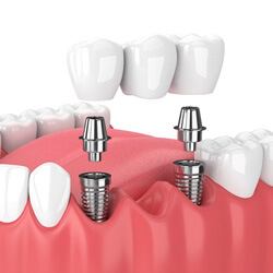3D render of a dental implant