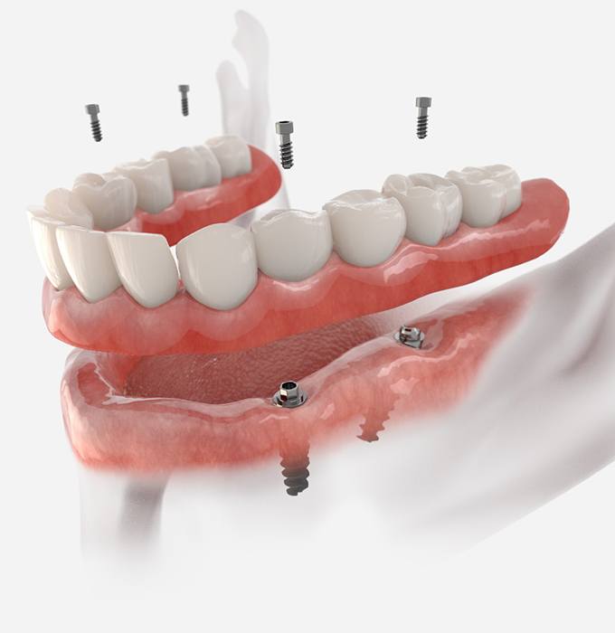 Mockup of implant dentures in Chelsea, MI being placed