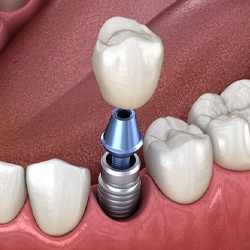 single dental implant with a crown