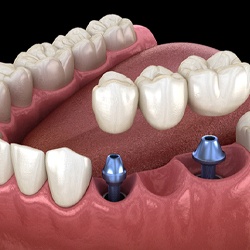 three dental implants with a bridge