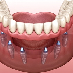 six dental implants with a full denture