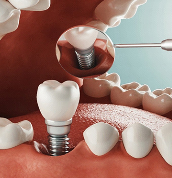 Diagram of how dental implants in Chelsea work