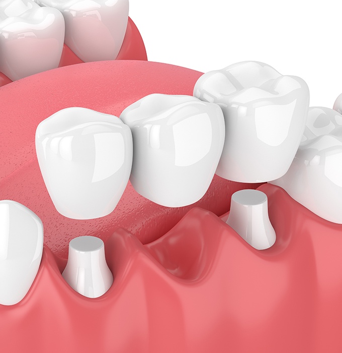 Animated dental bridge placement