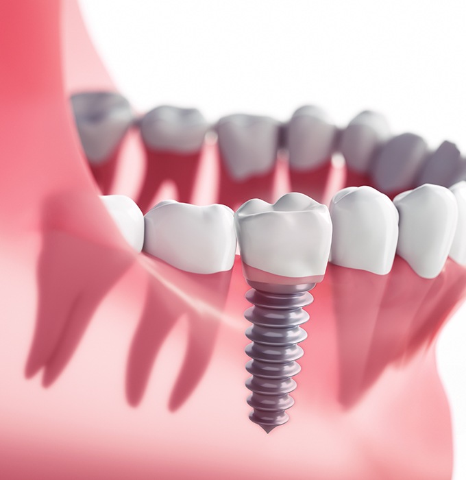 Animated dental implant supported dental crown