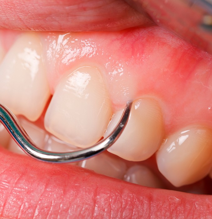 Closeup of smile during chao pinhole surgical technique treatment