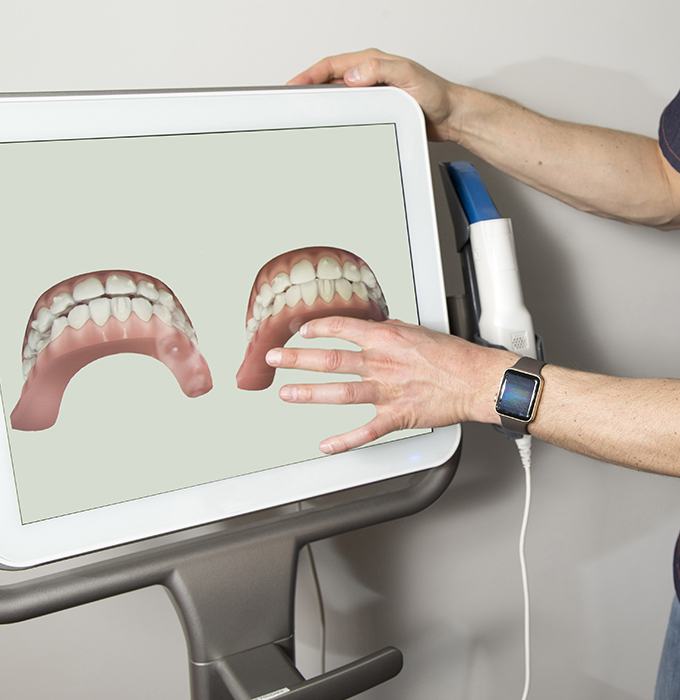 Digital smile impressions on chairside computer