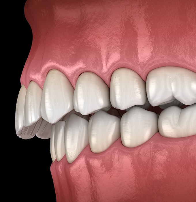 Animated smile in need of equilibration and occlusal adjustment