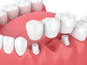 Model of a fixed dental bridge