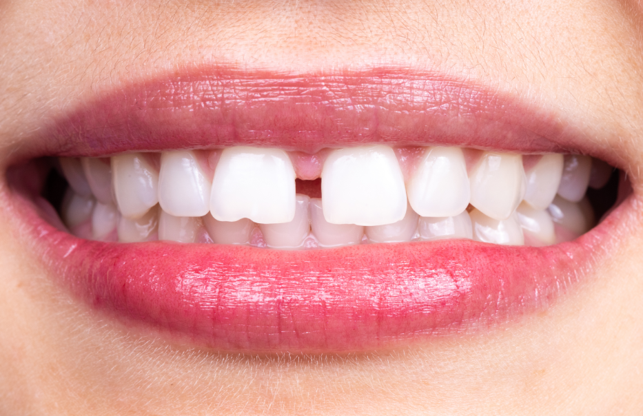 Close up of woman's smile with tooth gap