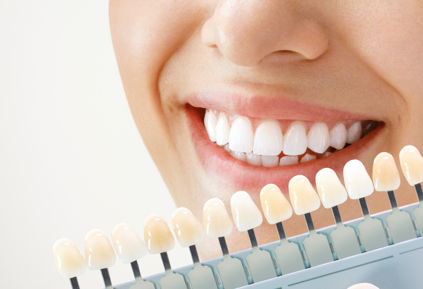 Close up of woman's smile with different whitening level options